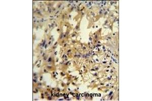 U antibody (C-term) (ABIN654948 and ABIN2844589) immunohistochemistry analysis in formalin fixed and paraffin embedded human kidney carcinoma followed by peroxidase conjugation of the secondary antibody and DAB staining. (UPP2 antibody  (C-Term))