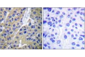 Immunohistochemistry analysis of paraffin-embedded human breast carcinoma, using Keratin 18 (Phospho-Ser33) Antibody. (Cytokeratin 18 antibody  (pSer34))