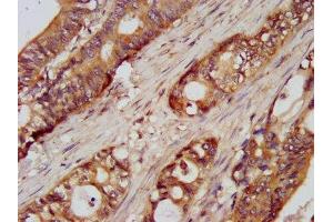 IHC image of ABIN7175108 diluted at 1:100 and staining in paraffin-embedded human colon cancer performed on a Leica BondTM system. (UMPS antibody  (AA 314-444))