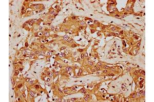 IHC image of nforHU diluted at 1:20 and staining in paraffin-embedded human liver cancer performed on a Leica BondTM system. (HIST1H1E antibody  (AA 57-69))