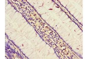 Immunohistochemistry of paraffin-embedded human colon cancer using ABIN7170709 at dilution of 1: 100 (STARD9 antibody  (AA 1960-2180))