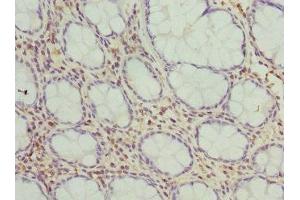 Immunohistochemistry of paraffin-embedded human colon cancer using ABIN7149954 at dilution of 1:100 (FMO1 antibody  (AA 363-532))