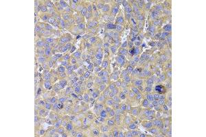 Immunohistochemistry of paraffin-embedded mouse cancer using HSPA14 antibody at dilution of 1:100 (x400 lens).