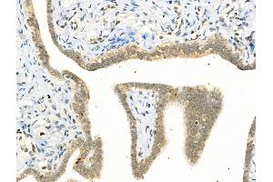 Phospho-YY1 (Ser365) Antibody at 1/100 staining Human ovarian cancer by IHC-P.