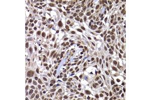 Immunohistochemistry of paraffin-embedded human well-differentiated squamous skin carcinoma using DNAJB6 antibody (ABIN5974242) at dilution of 1/100 (40x lens). (DNAJB6 antibody)