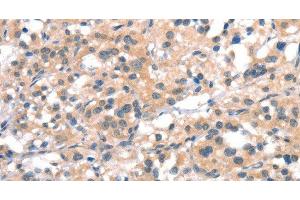 Immunohistochemistry of paraffin-embedded Human thyroid cancer tissue using CYP2D6 Polyclonal Antibody at dilution 1:40 (CYP2D6 antibody)