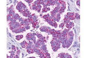 Anti-SMO / Smoothened antibody IHC of human Ovary, Carcinoma. (SMO antibody  (1st Extracellular Domain))