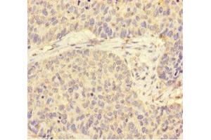 Immunohistochemistry of paraffin-embedded human ovarian cancer using ABIN7170819 at dilution of 1:100 (STIP1 antibody  (AA 1-543))