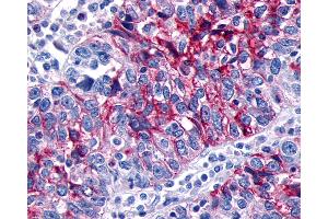 Anti-GPR133 antibody IHC of human Ovary, Carcinoma. (G Protein-Coupled Receptor 133 antibody  (N-Term))