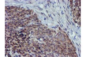 Immunohistochemical staining of paraffin-embedded Adenocarcinoma of Human breast tissue using anti-ALOX15 mouse monoclonal antibody.