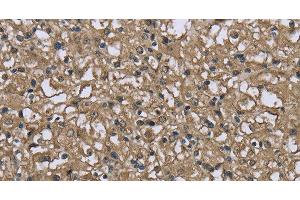 Immunohistochemistry of paraffin-embedded Human prostate cancer using FBP1 Polyclonal Antibody at dilution of 1:40 (FBP1 antibody)