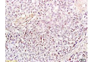 Formalin-fixed and paraffin embedded human endometrium carcinoma labeled Anti-HMGB1 Polyclonal Antibody, Unconjugated (ABIN671616) at 1:200, followed by conjugation to the secondary antibody and DAB staining (HMGB1 antibody  (AA 75-170))
