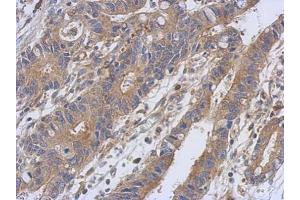 IHC-P Image Immunohistochemical analysis of paraffin-embedded human colon carcinoma, using PKC alpha, antibody at 1:500 dilution. (PKC alpha antibody  (N-Term))