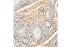 Immunohistochemistry analysis in formalin fixed and paraffin embedded human prostate carcinoma reacted with PCOTH Antibody (Center) followed by peroxidase conjugation of the secondary antibody and DAB staining. (PCOTH antibody  (Middle Region))