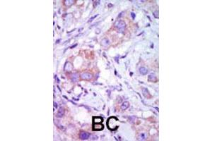 Formalin-fixed and paraffin-embedded human cancer tissue reacted with the MAP3K9 polyclonal antibody  , which was peroxidase-conjugated to the secondary antibody, followed by DAB staining. (MAP3K9 antibody  (C-Term))
