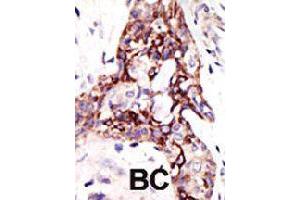 Formalin-fixed and paraffin-embedded human cancer tissue reacted with ARL3 polyclonal antibody  , which was peroxidase-conjugated to the secondary antibody, followed by DAB staining . (ARL3 antibody  (C-Term))