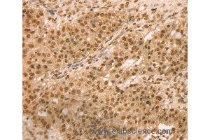 Immunohistochemistry of Human breast cancer using SNX8 Polyclonal Antibody at dilution of 1:25 (SNX8 antibody)