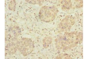 Immunohistochemistry of paraffin-embedded human gastric cancer using ABIN7175005 at dilution of 1:100 (MRPL46 antibody  (AA 28-153))