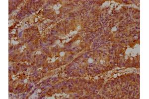 IHC image of ABIN7157186 diluted at 1:100 and staining in paraffin-embedded human colon cancer performed on a Leica BondTM system. (KALRN antibody  (AA 2410-2661))