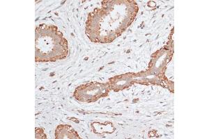 Immunohistochemistry of paraffin-embedded human breast cancer using ABCC5 antibody (ABIN6291734) at dilution of 1:100 (40x lens). (ABCC5 antibody)
