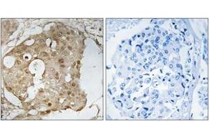 Immunohistochemistry analysis of paraffin-embedded human breast carcinoma, using p53 (Phospho-Ser366) Antibody. (p53 antibody  (pSer366))