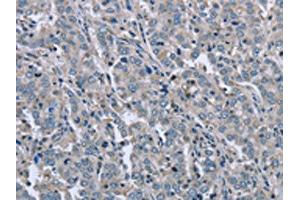 The image on the left is immunohistochemistry of paraffin-embedded Human liver cancer tissue using ABIN7129455(FAR2 Antibody) at dilution 1/50, on the right is treated with fusion protein. (FAR2 antibody)