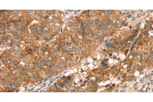 Immunohistochemistry of paraffin-embedded Human breast cancer using PDLIM4 Polyclonal Antibody at dilution of 1:30