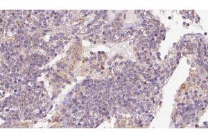 ABIN6273169 at 1/100 staining Human lymph cancer tissue by IHC-P. (STAU1/Staufen antibody  (Internal Region))