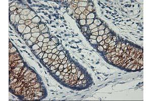 Immunohistochemical staining of paraffin-embedded Adenocarcinoma of Human ovary tissue using anti-PVRL1 mouse monoclonal antibody. (PVRL1 antibody)