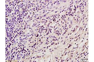 Formalin-fixed and paraffin embedded mouse tumor tissue labeled with Anti SORBS2 Polyclonal Antibody, Unconjugated (ABIN1387807) at 1:200 followed by conjugation to the secondary antibody and DAB staining (Sorbs2 antibody  (AA 401-500))