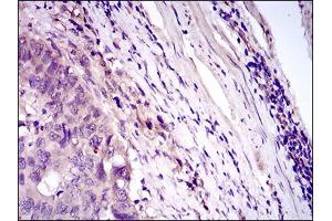 Immunohistochemical analysis of paraffin-embedded esophageal cancer tissues using CD33 mouse mAb with DAB staining.