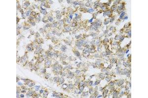 Immunohistochemistry of paraffin-embedded Human esophageal cancer using ZAK Polyclonal Antibody at dilution of 1:100 (40x lens). (ZAK antibody)