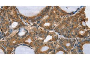 Immunohistochemistry of paraffin-embedded Human thyroid cancer using TRIM3 Polyclonal Antibody at dilution of 1:45 (TRIM3 antibody)