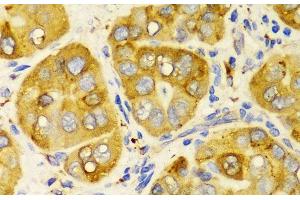Immunohistochemistry of paraffin-embedded Human liver cancer using LRPAP1 Polyclonal Antibody at dilution of 1:100 (40x lens). (LRPAP1 antibody)