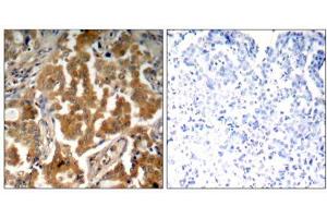 Immunohistochemical analysis of paraffin- embedded human lung carcinoma tissue using ADD1 (Phospho- Ser726) antibody (E011182). (alpha Adducin antibody  (pSer726))