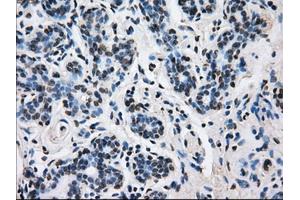 Immunohistochemical staining of paraffin-embedded breast tissue using anti-L1CAM mouse monoclonal antibody. (L1CAM antibody)