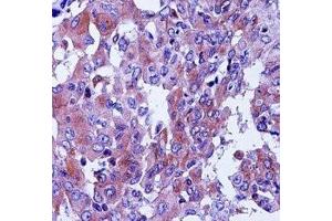 CD55 antibody immunohistochemistry analysis in formalin fixed and paraffin embedded human lung adenocarcinoma. (CD55 antibody  (AA 51-79))