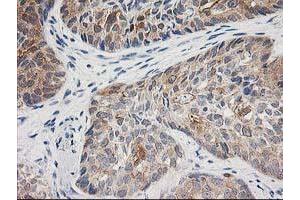 Immunohistochemical staining of paraffin-embedded Adenocarcinoma of Human breast tissue using anti-TOMM34 mouse monoclonal antibody. (TOMM34 antibody)