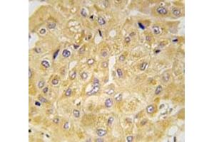 IHC analysis of FFPE human hepatocarcinoma tissue stained with Integrin linked kinase antibody