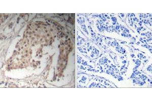 Immunohistochemical analysis of paraffin-embedded human breast carcinoma tissue using HNF4α (Ab-304) Antibody (E021043). (HNF4A antibody)