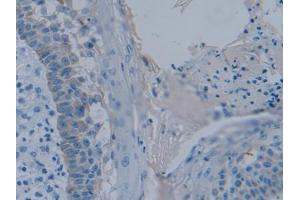 DAB staining on IHC-P; Samples: Human Skin cancer Tissue (PLAA antibody  (AA 367-468))