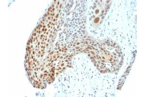 Formalin-fixed, paraffin-embedded human Cervical Tumor stained with Phospho c-Jun Mouse Monoclonal Antibody (C-J 4C4/1).