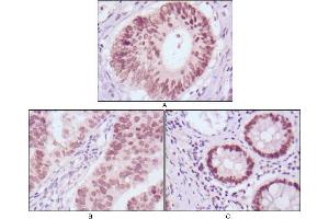 Immunohistochemical analysis of paraffin-embedded human colon cancer (A), gastric cancer (B) and rectal cancer (C) tissues using FOXA2 mouse mAb with DAB staining. (FOXA2 antibody)