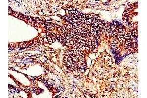 IHC image of ABIN7149184 diluted at 1:200 and staining in paraffin-embedded human colon cancer performed on a Leica BondTM system. (Cytochrome C antibody  (AA 2-105))