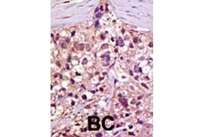 Formalin-fixed and paraffin-embedded human cancer tissue reacted with the primary antibody, which was peroxidase-conjugated to the secondary antibody, followed by AEC staining. (E1 Ubiquitin (AA 1026-1058), (C-Term) antibody)