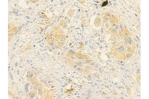 ABIN7095788 and ABIN7099850 at 1/100 staining human tongue carcinoma by IHC-P.