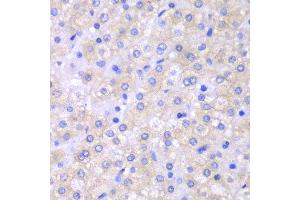 Immunohistochemistry of paraffin-embedded human liver cancer using SH2D1A antibody at dilution of 1:100 (400x lens).