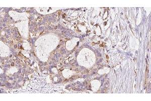 ABIN6273046 at 1/100 staining Human liver cancer tissue by IHC-P.