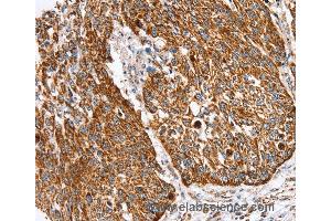 Immunohistochemistry of Human lung cancer using SSBP1 Polyclonal Antibody at dilution of 1:30 (SSBP1 antibody)
