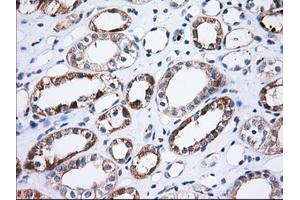 Immunohistochemical staining of paraffin-embedded Adenocarcinoma of Human ovary tissue using anti-TTC32 mouse monoclonal antibody. (TTC32 antibody)